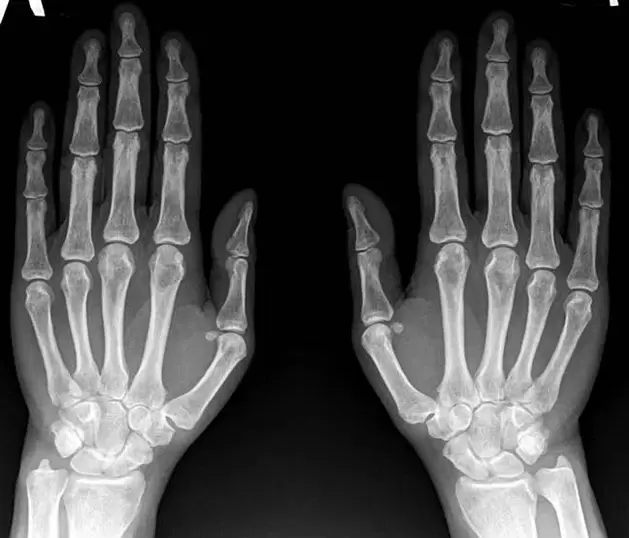 Arthritis of the wrist on x-ray before using Hondroine