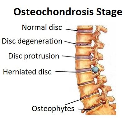 Stadiums of osteochondrosis