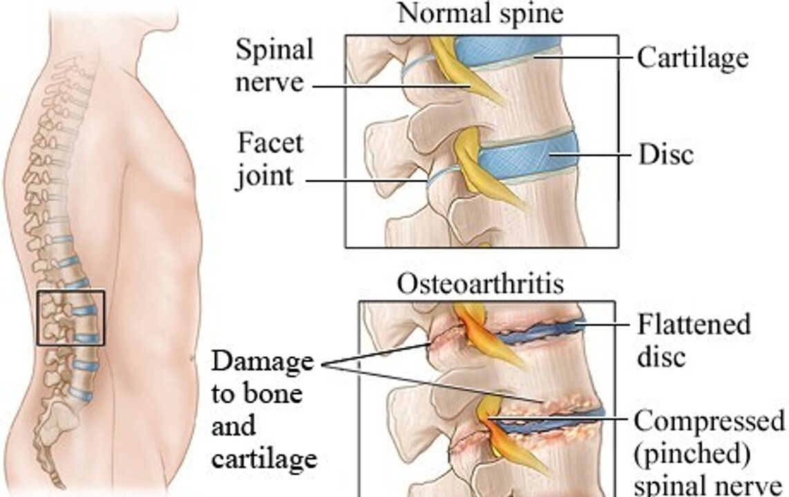 The difference between a healthy disc and a slice with osteochondrosis
