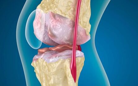 The reasons for the development of osteoarthritis of the knee joint
